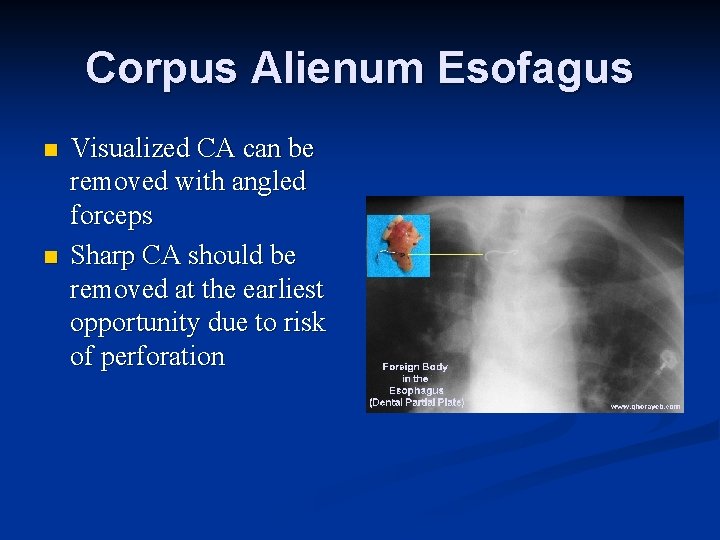 Corpus Alienum Esofagus n n Visualized CA can be removed with angled forceps Sharp