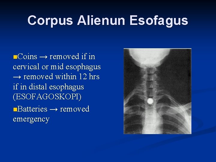Corpus Alienun Esofagus n. Coins → removed if in cervical or mid esophagus →