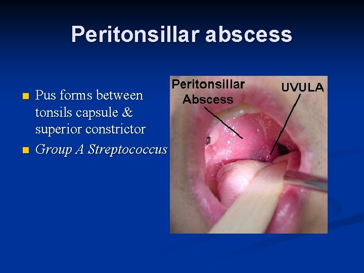 Peritonsillar abscess n n Pus forms between tonsils capsule & superior constrictor Group A