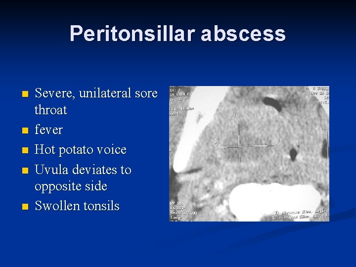 Peritonsillar abscess n n n Severe, unilateral sore throat fever Hot potato voice Uvula