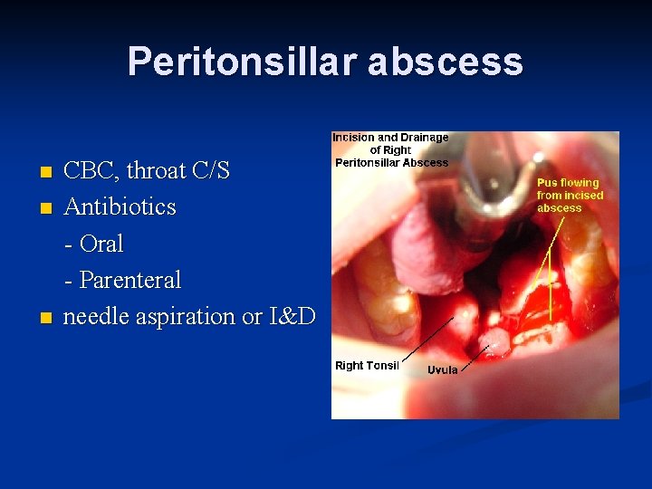 Peritonsillar abscess n n n CBC, throat C/S Antibiotics - Oral - Parenteral needle