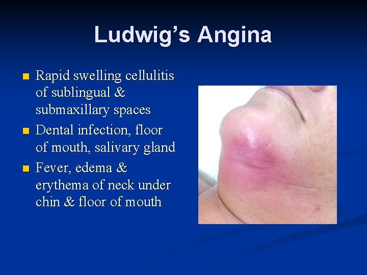 Ludwig’s Angina n n n Rapid swelling cellulitis of sublingual & submaxillary spaces Dental