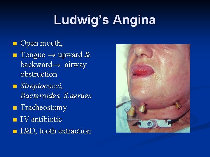 Ludwig’s Angina n n n Open mouth, Tongue → upward & backward→ airway obstruction