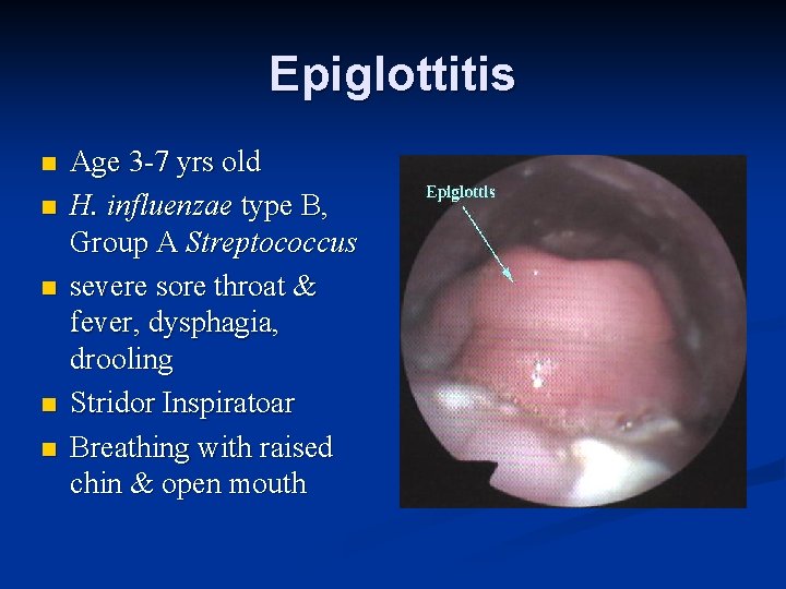 Epiglottitis n n n Age 3 -7 yrs old H. influenzae type B, Group