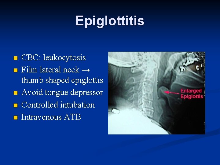 Epiglottitis n n n CBC: leukocytosis Film lateral neck → thumb shaped epiglottis Avoid