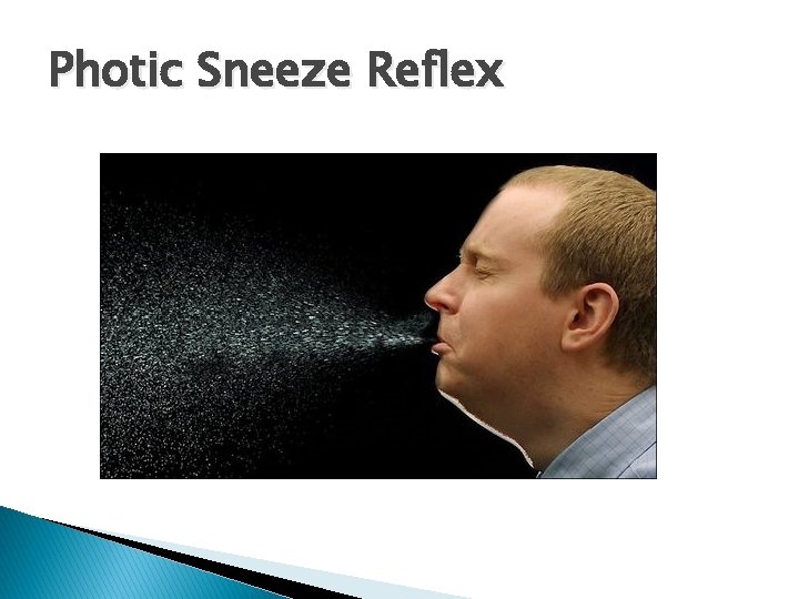 Photic Sneeze Reflex 