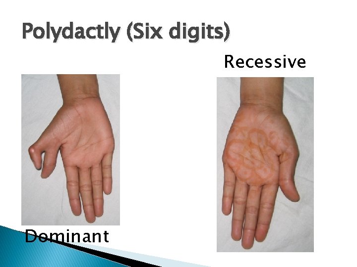 Polydactly (Six digits) Recessive Dominant 