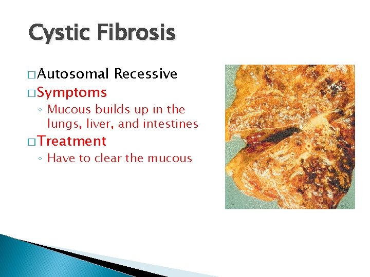 Cystic Fibrosis � Autosomal � Symptoms Recessive ◦ Mucous builds up in the lungs,