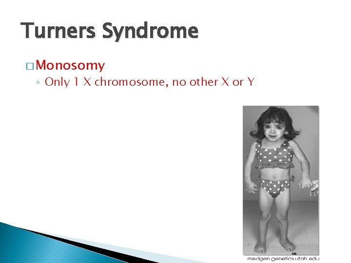 Turners Syndrome � Monosomy ◦ Only 1 X chromosome, no other X or Y