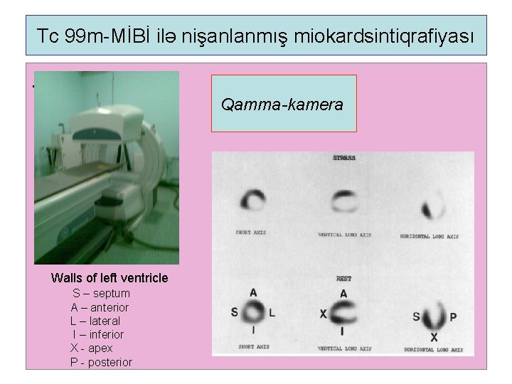 Tc 99 m-MİBİ ilə nişanlanmış miokardsintiqrafiyası . Qamma-kamera Walls of left ventricle S –