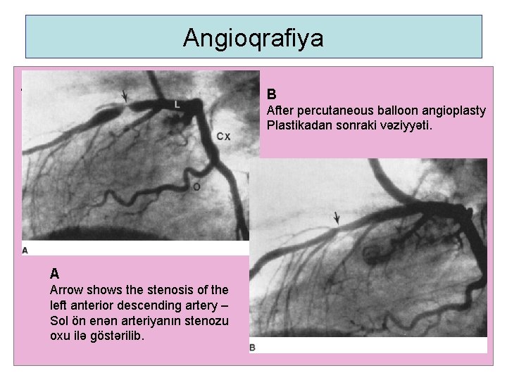 Angioqrafiya. B After percutaneous balloon angioplasty Plastikadan sonraki vəziyyəti. A Arrow shows the stenosis