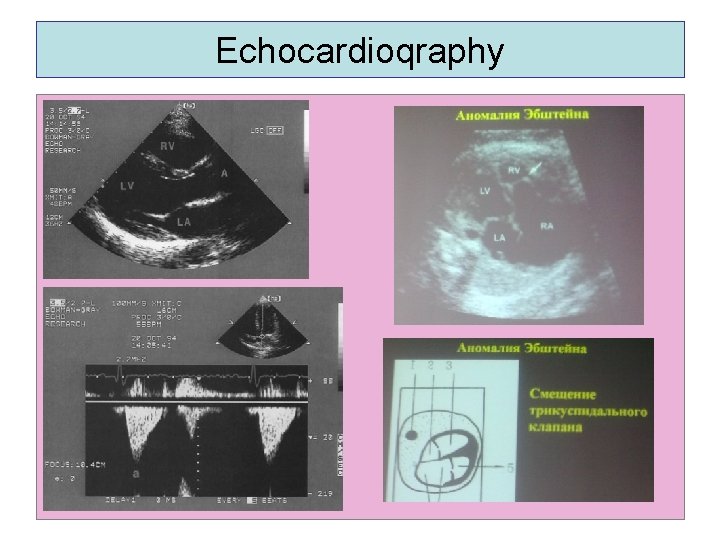 Echocardioqraphy. 
