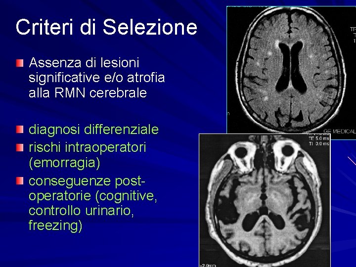 Criteri di Selezione Assenza di lesioni significative e/o atrofia alla RMN cerebrale diagnosi differenziale