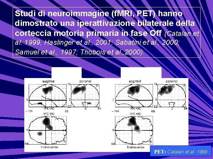Studi di neuroimmagine (f. MRI, PET) hanno dimostrato una iperattivazione bilaterale della corteccia motoria