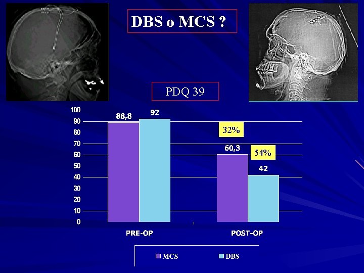 DBS o MCS ? PDQ 39 32% 54% 