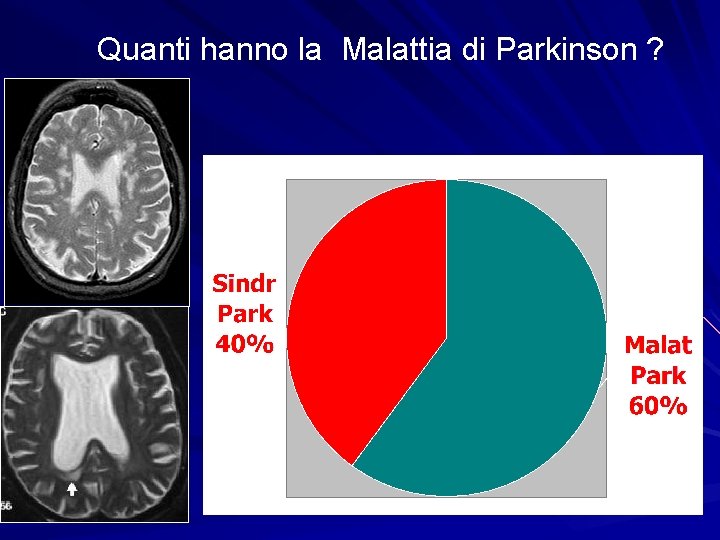 Quanti hanno la Malattia di Parkinson ? • 