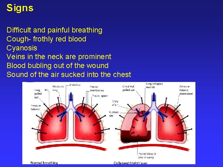 Signs Difficult and painful breathing Cough- frothly red blood Cyanosis Veins in the neck