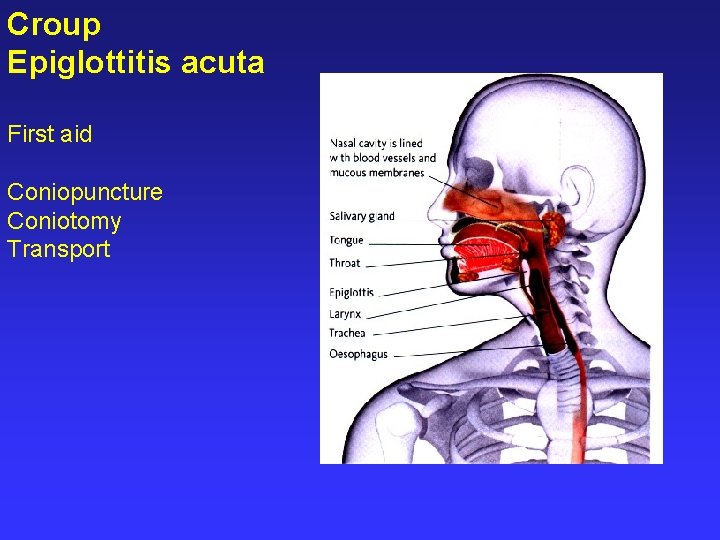 Croup Epiglottitis acuta First aid Coniopuncture Coniotomy Transport 