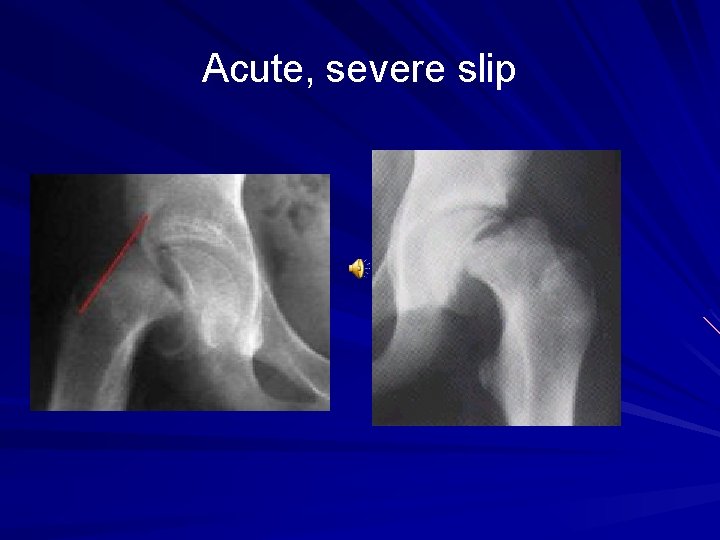 Acute, severe slip 