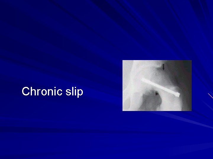 Chronic slip 