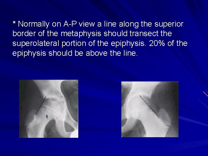 * Normally on A-P view a line along the superior border of the metaphysis