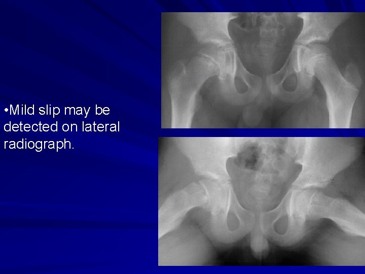  • Mild slip may be detected on lateral radiograph. 