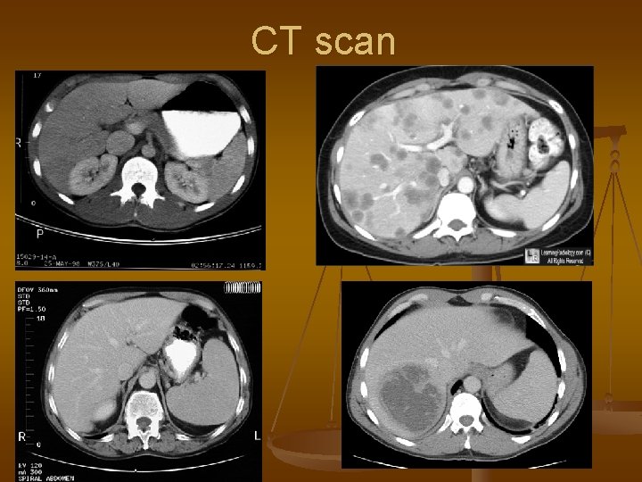 CT scan 