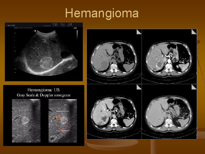 Hemangioma 