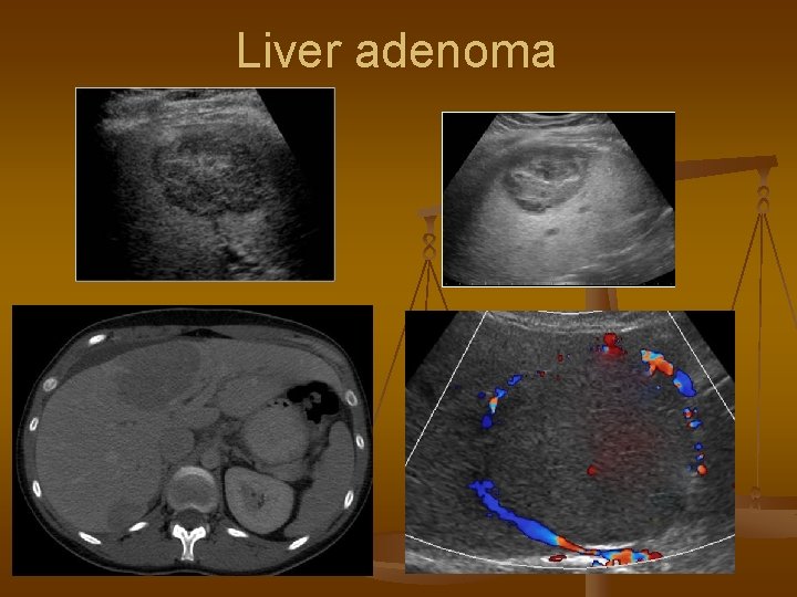 Liver adenoma 