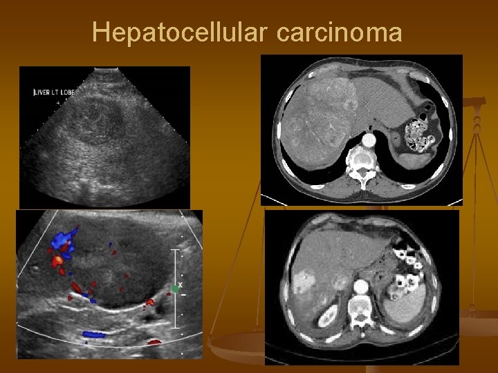 Hepatocellular carcinoma 