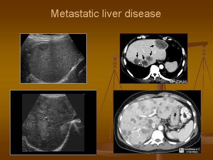 Metastatic liver disease 