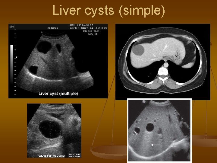 Liver cysts (simple) 