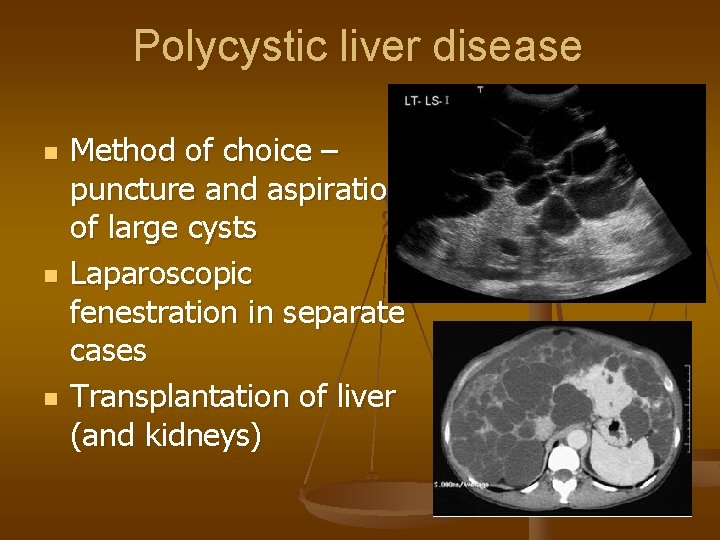 Polycystic liver disease n n n Method of choice – puncture and aspiration of