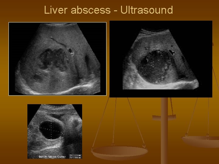 Liver abscess - Ultrasound 