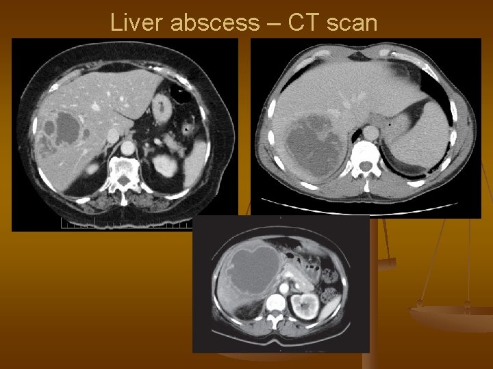 Liver abscess – CT scan 