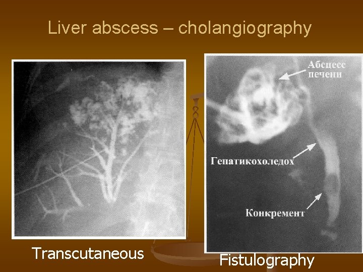 Liver abscess – cholangiography Transcutaneous Fistulography 