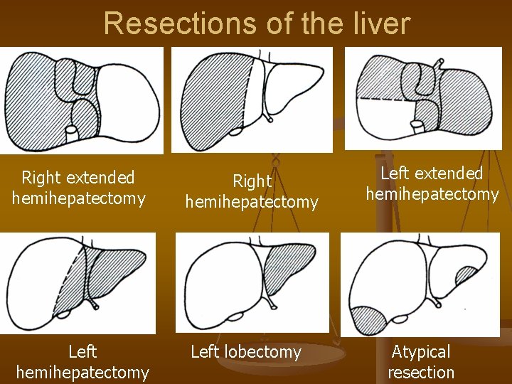Resections of the liver Right extended hemihepatectomy Left hemihepatectomy Right hemihepatectomy Left lobectomy Left