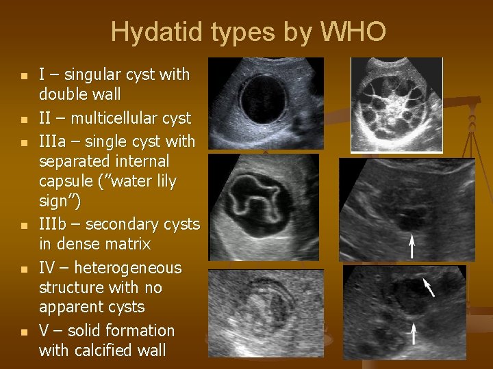 Hydatid types by WHO n n n I – singular cyst with double wall