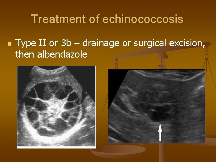 Treatment of echinococcosis n Type II or 3 b – drainage or surgical excision,