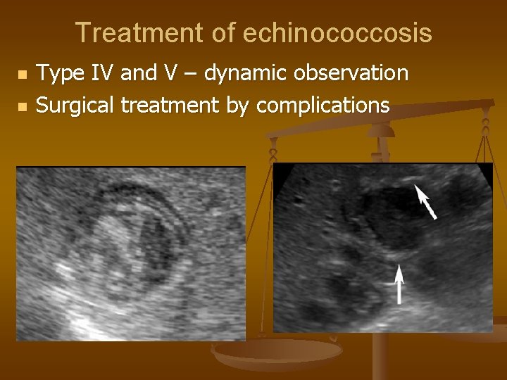 Treatment of echinococcosis n n Type IV and V – dynamic observation Surgical treatment