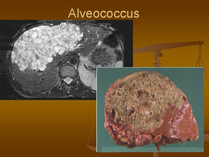 Alveococcus 