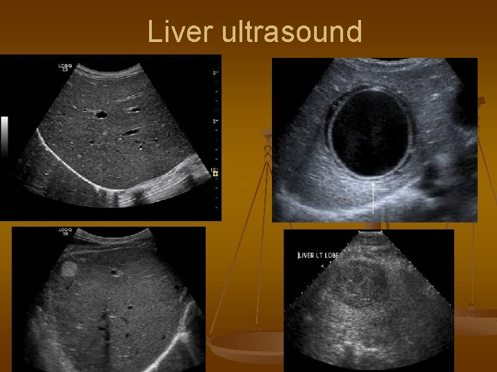 Liver ultrasound 