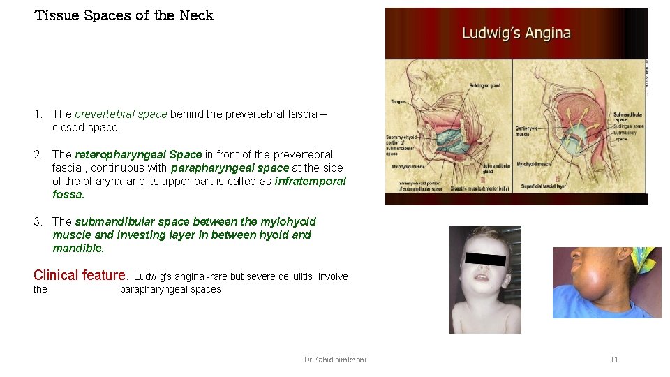 Tissue Spaces of the Neck 1. The prevertebral space behind the prevertebral fascia –