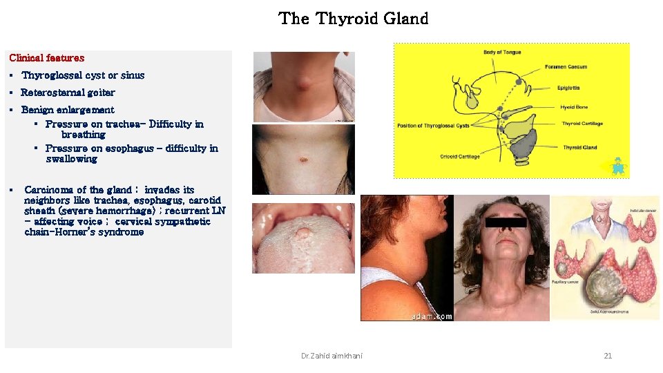 The Thyroid Gland Clinical features § Thyroglossal cyst or sinus § Reterosternal goiter §