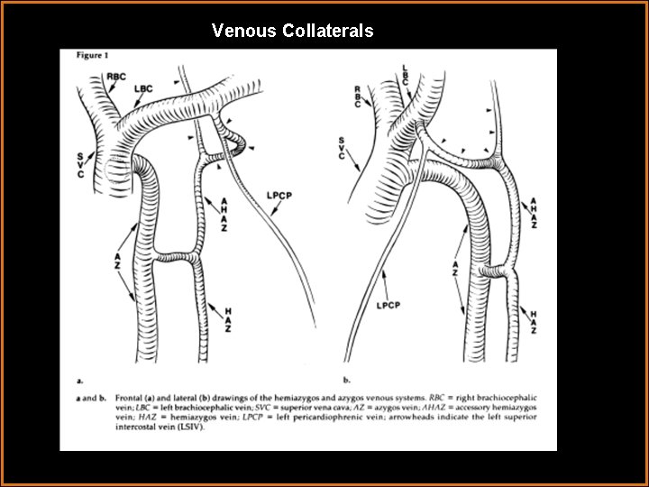 Venous Collaterals 1 