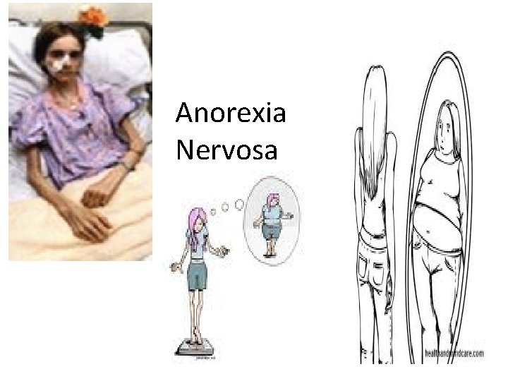 Anorexia Nervosa 