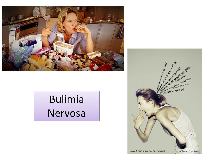Bulimia Nervosa 