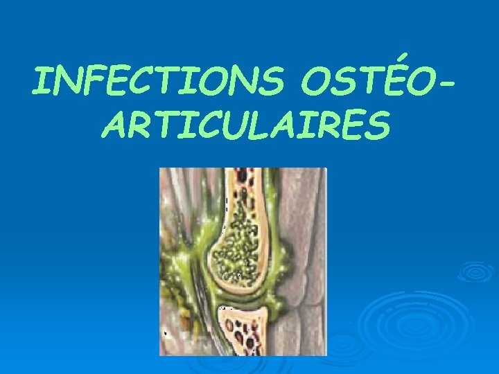 INFECTIONS OSTÉOARTICULAIRES 