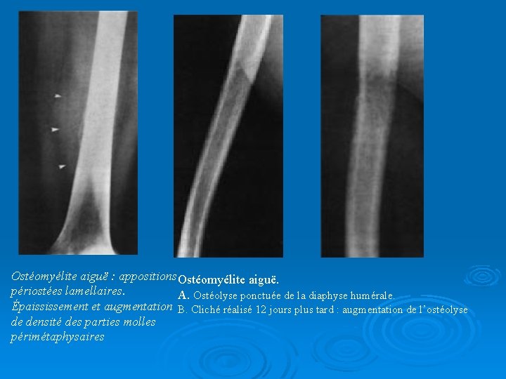 Ostéomyélite aiguë : appositions Ostéomyélite aiguë. périostées lamellaires. A. Ostéolyse ponctuée de la diaphyse