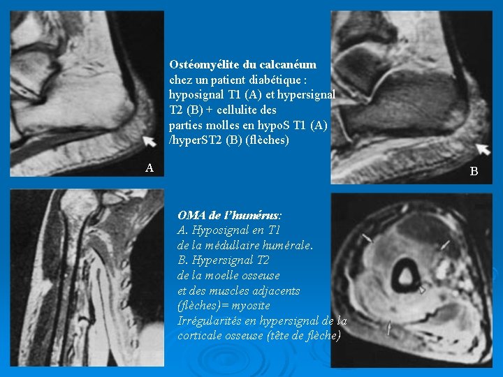 Ostéomyélite du calcanéum chez un patient diabétique : hyposignal T 1 (A) et hypersignal